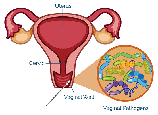 Vaginal pathogens can be collected with a swab from the vaginal wall.